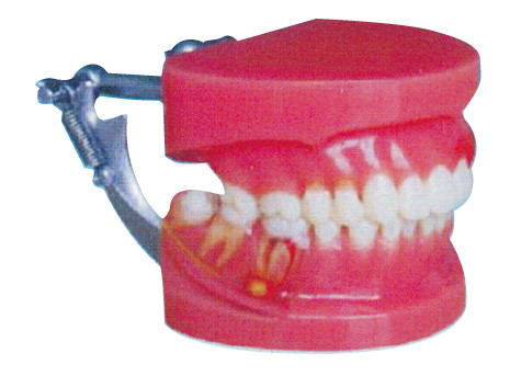 General modelo doutor dos dentes humanos vermelhos e brancos da demonstração da doença peridental